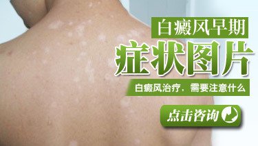 白癜风图片 白癜风症状图片